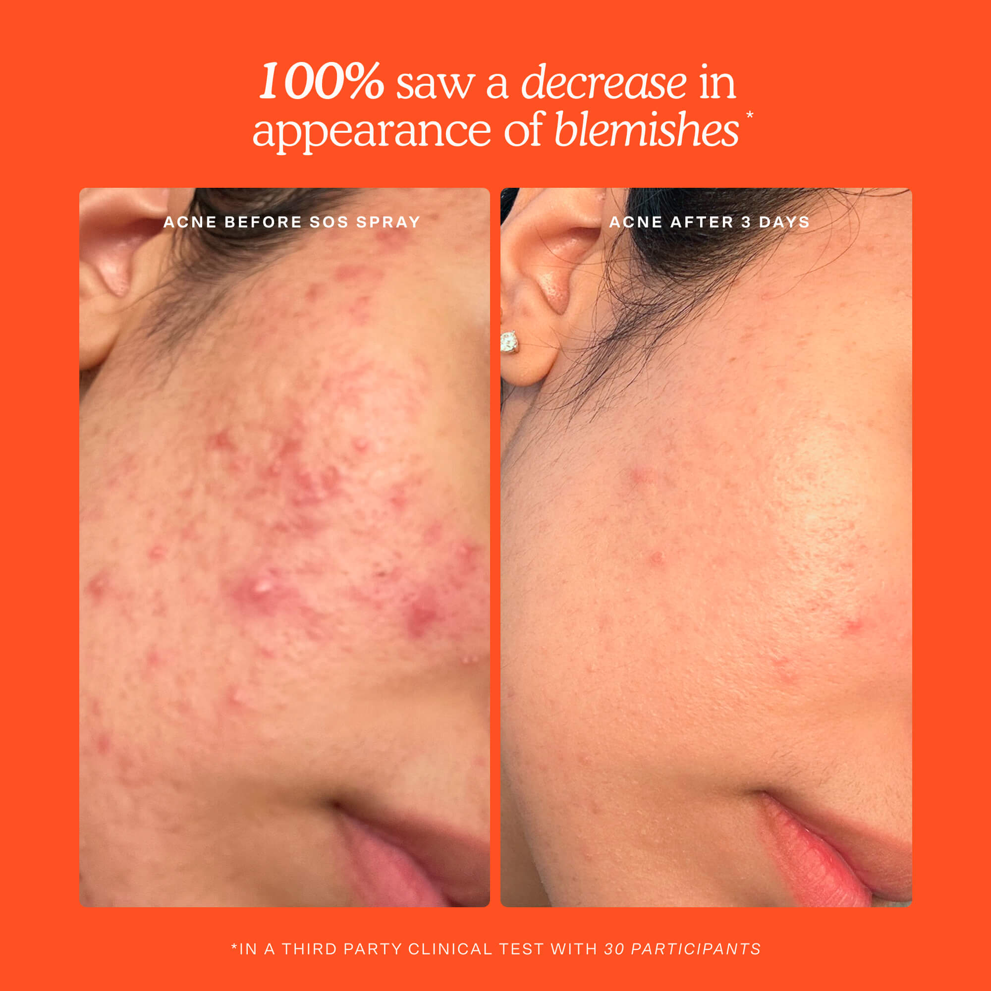 Before and after comparison of acne treatment with a clinical test result on an orange background. [Shared]