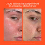 Before and after comparison of skin redness reduction with a spray product on an orange background. [Shared]